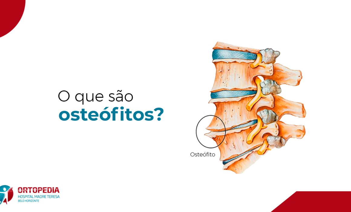 Osteófitos Marginais Nos Corpos Vertebrais Lombares - BRAINCP