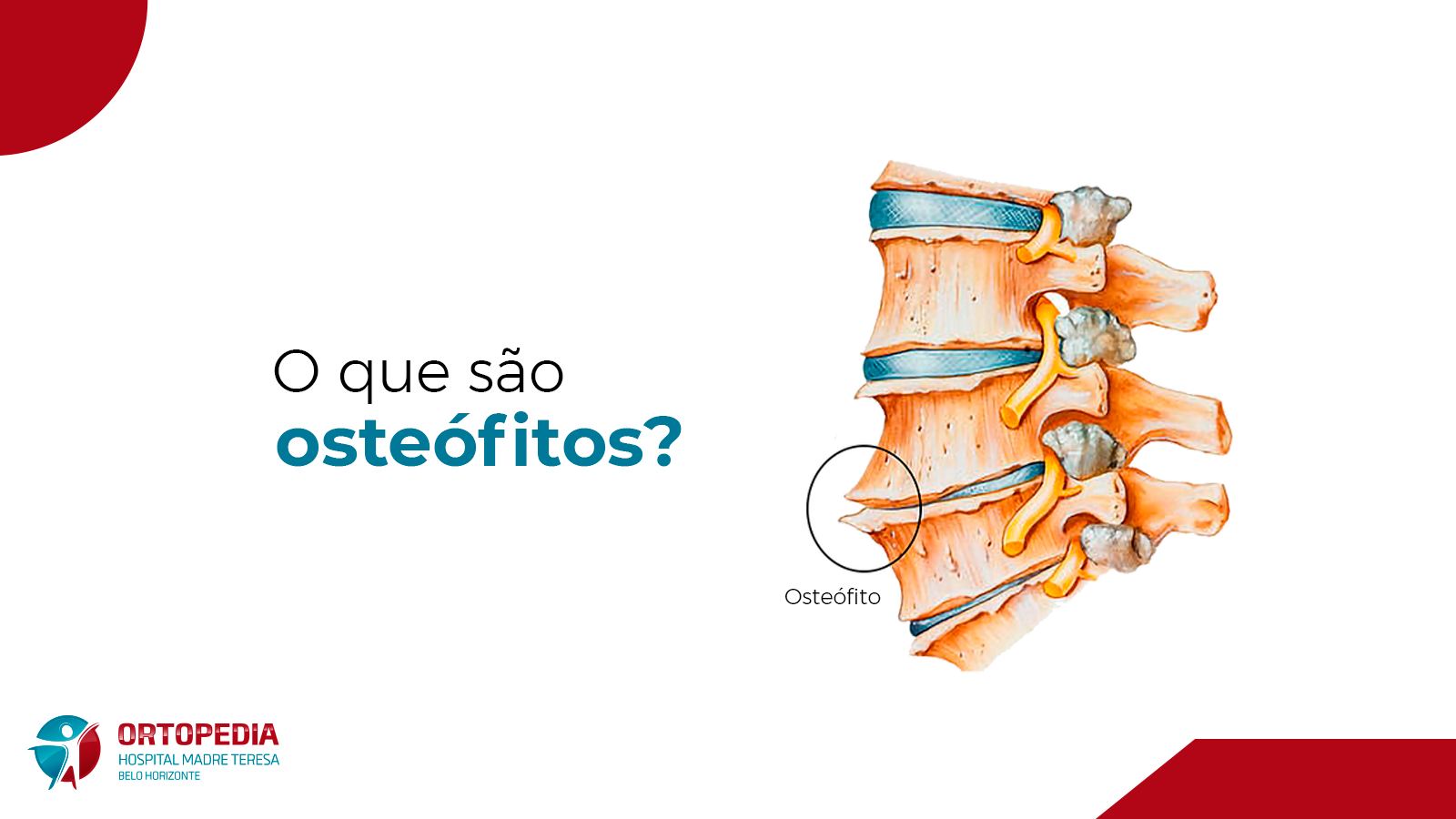 Osteofitos Marginais Na Coluna Dorsal - BRAINCP